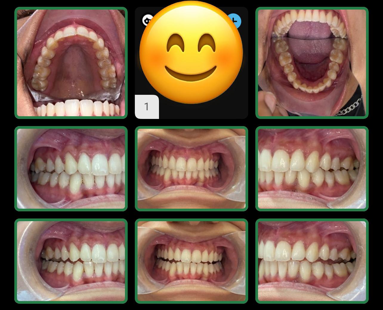 Teeth Straightening Treatment Guildford