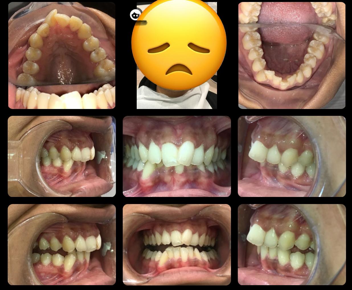 Invisalign Invisible Braces