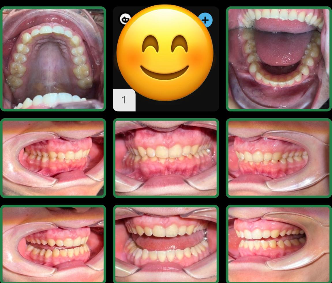 Invisalign Consultation Service