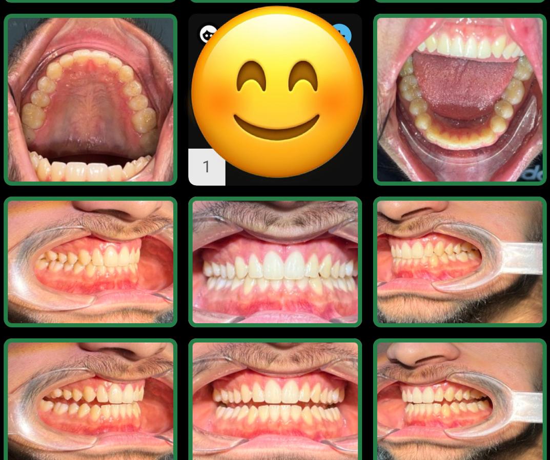 Teeth Straightening Treatments