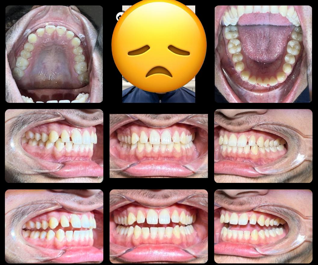Teeth Straighter Treatment