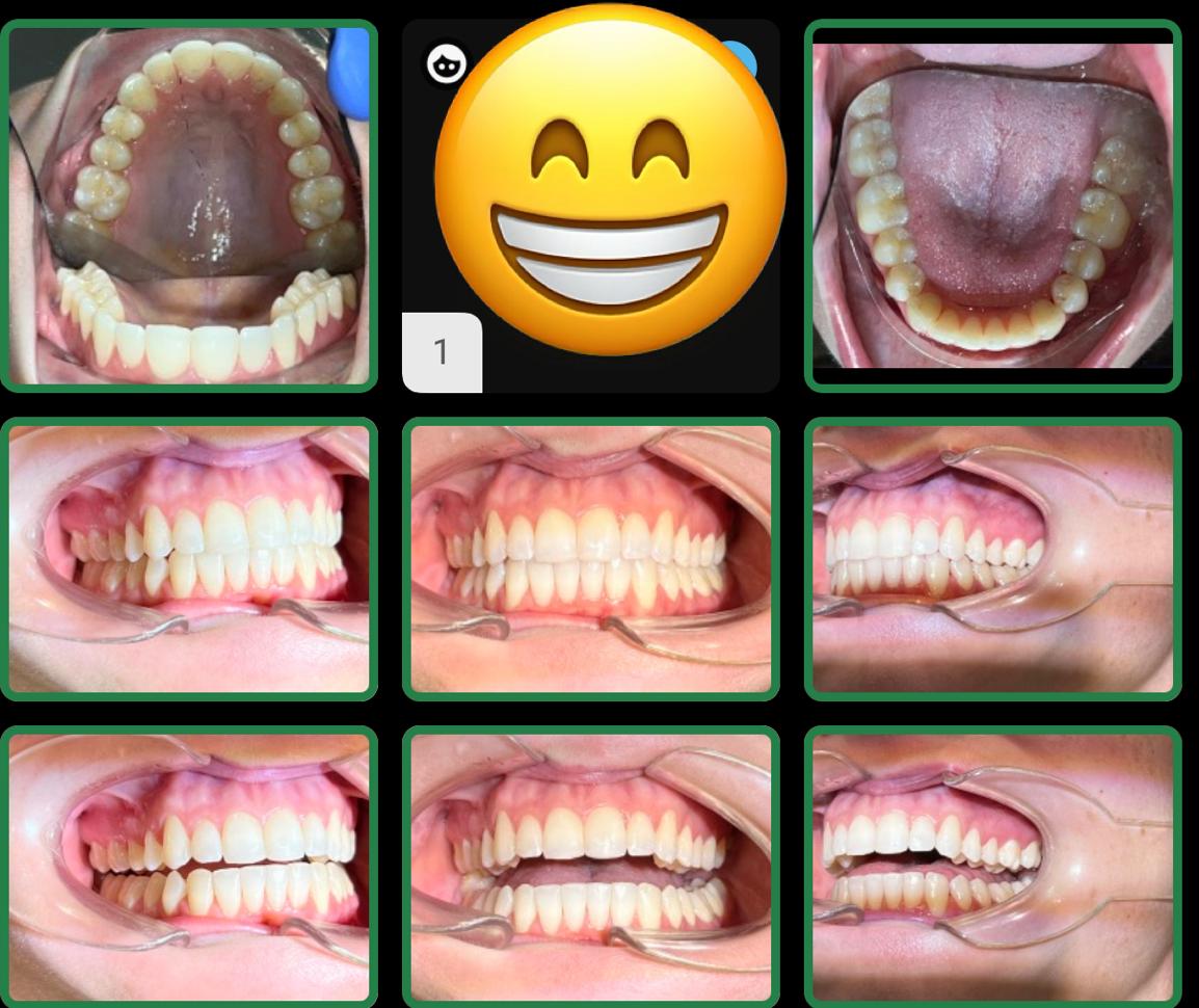 Invisalign Invisible Braces Treatment
