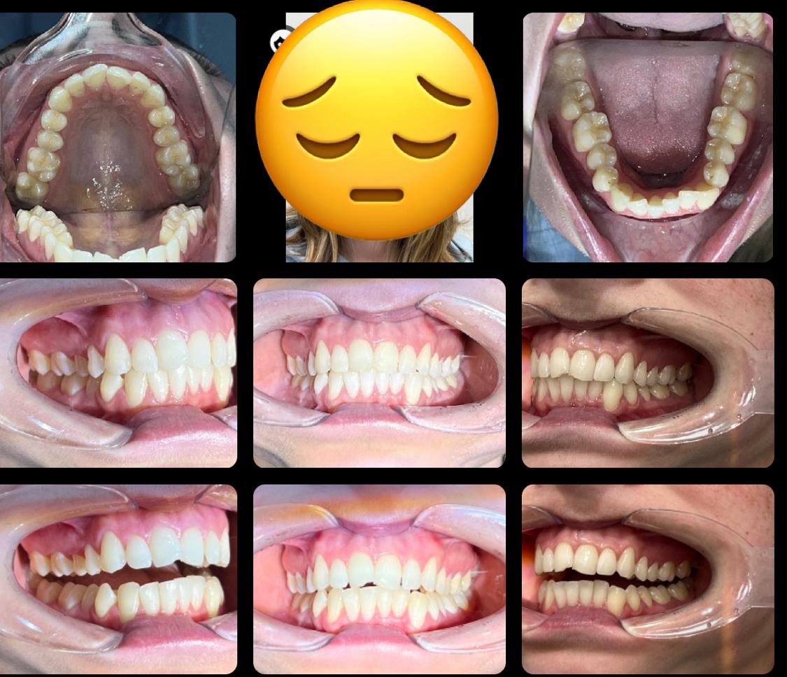 Virtually Invisalign Invisible Braces