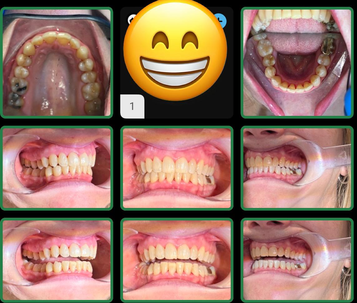Durable Teeth Straighter Treatment